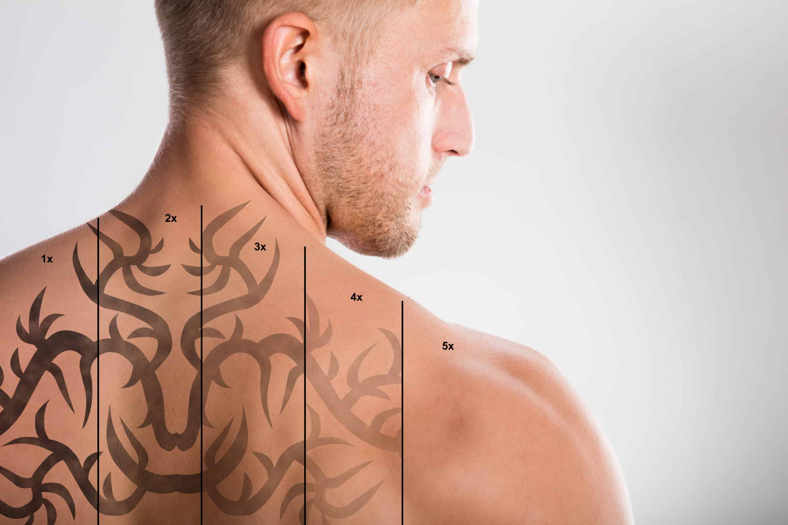 laser tattoo removal the truth about side effects
